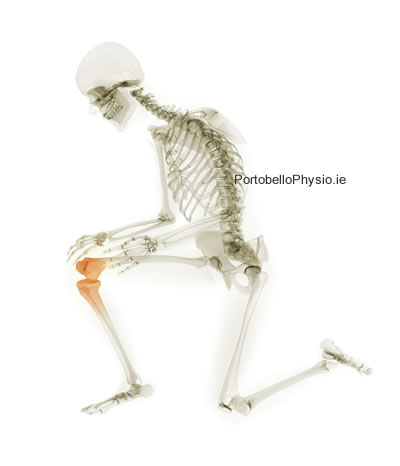 Arthritis