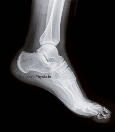 avulsion-fracture