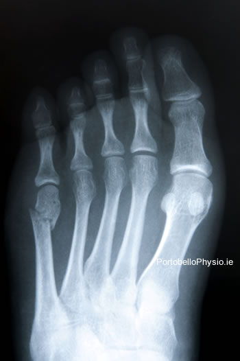 stress-fracture