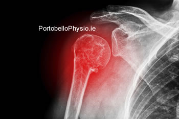 Dislocated-Shoulder