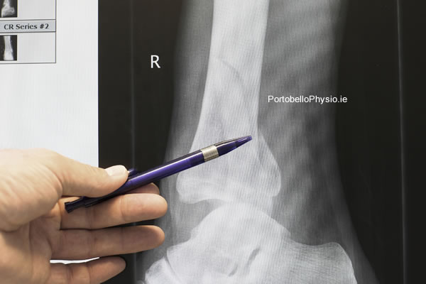 Fractures
