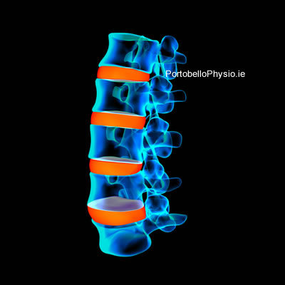 disc-related-lower-back-pain